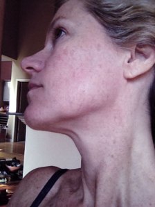 hyperpigmentation and rosacea